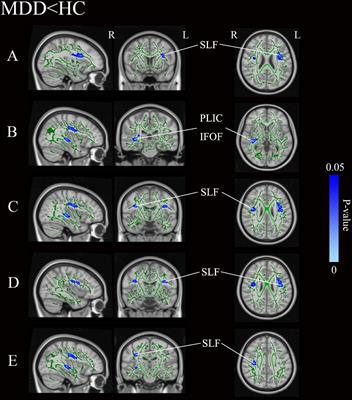 Alterations in the white matter structure of major depressive disorder patients and their link to childhood trauma